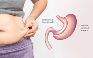 gastric sleeve
